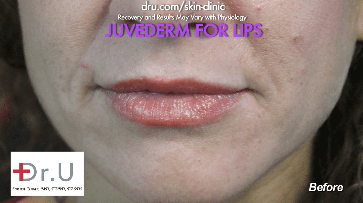This patient sought a natural looking lip augmentation outcome.