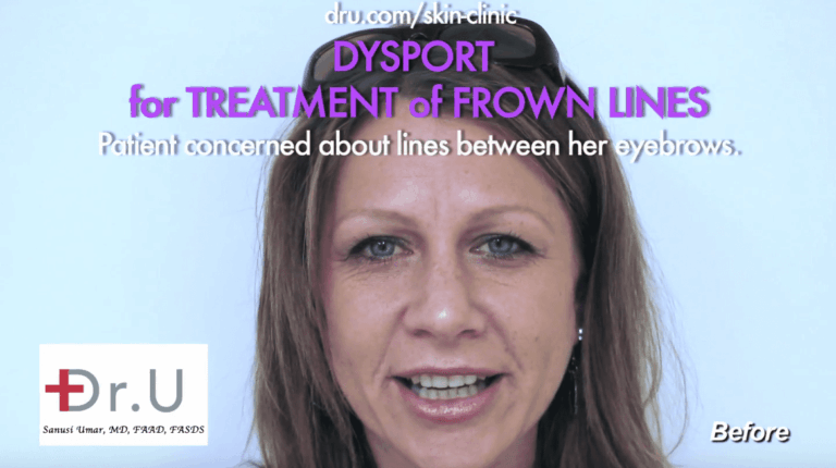 Get rid of furrow lines between eyebrows with Dysport at Dr. U Hair & Skin Clinic.*