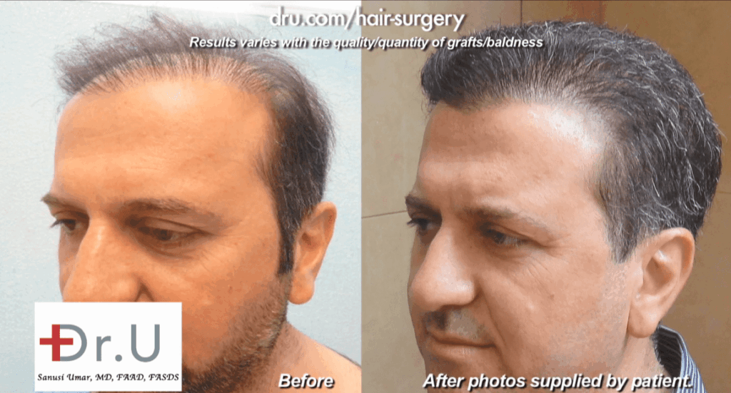 before and after surgery with Dr. U to repair a botched hair transplant outcome
