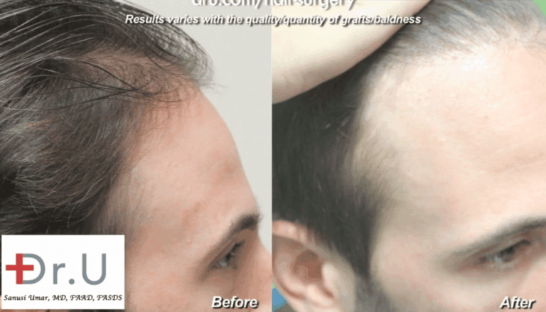 Dr. Umar was able to recreate hairline and temples in a celebrity Dr. Umar was able to recreate hairline and temples in a celebrity