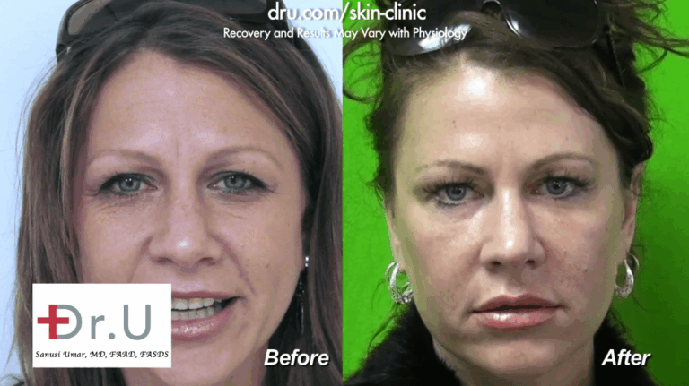 Dysport in forehead before and after proved highly effective and natural-looking for this Dr. U patient.*