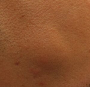 Benign cysts are harmless. But their appearance can still be distressing for patients, which is why many opt to have them removed. Los Angeles dermatologist Dr. Umar has years of experience in cyst removal for a normal cosmetic appearance. Benign cysts are harmless. But their appearance can still be distressing for patients, which is why many opt to have them removed. Los Angeles dermatologist Dr. Umar has years of experience in cyst removal for a normal cosmetic appearance.
