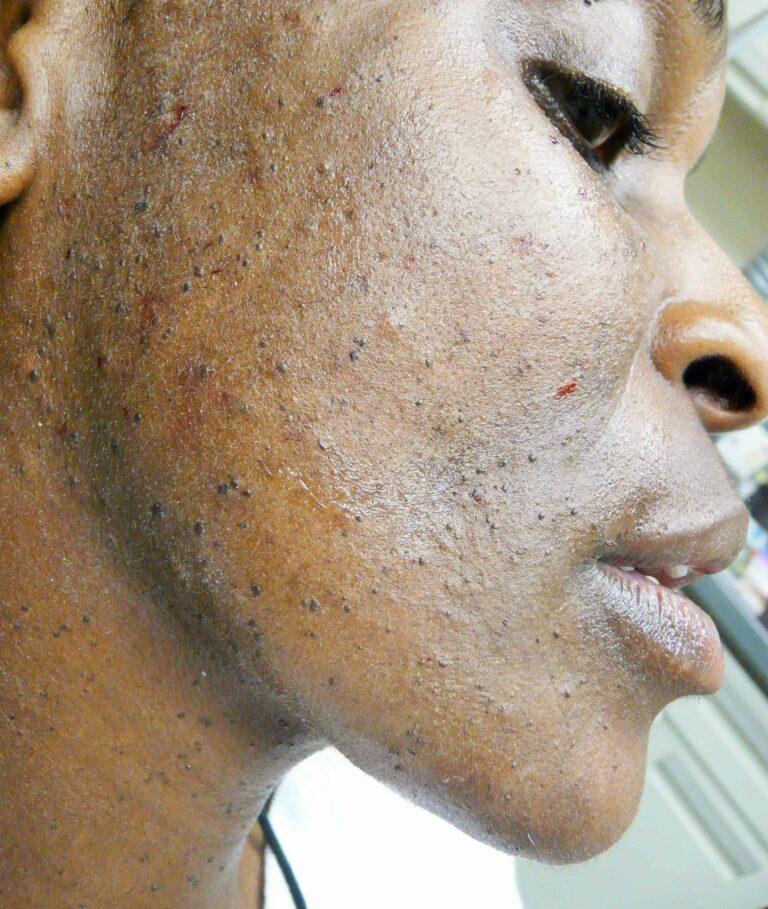 A qualified dermatologist will offer the right skin tag treatment, whether or not one or multiple areas are targeted. This patient consulted Dr. Umar for DPN skin tag removal with pain management. 