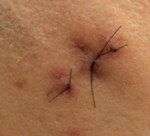 A surgical cyst removal will get rid of all troublesome tissue beneath the skin to prevent recurrence. As an experienced, double-certified dermatologist, Dr. Umar performs safe and efficient surgical cyst removal procedures in his Los Angeles skin clinic. A surgical cyst removal will get rid of all troublesome tissue beneath the skin to prevent recurrence. As an experienced, double-certified dermatologist, Dr. Umar performs safe and efficient surgical cyst removal procedures in his Los Angeles skin clinic.