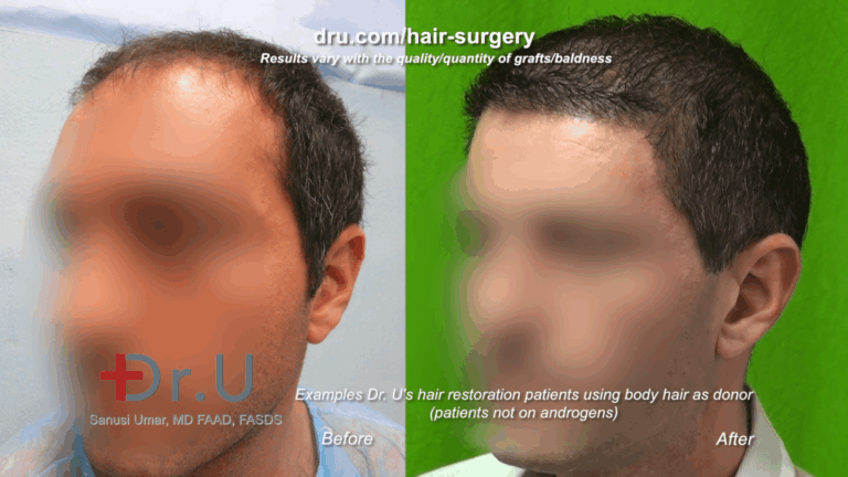 This Los Angeles patient benefited from a body hair to head restoration with Dr. Umar.