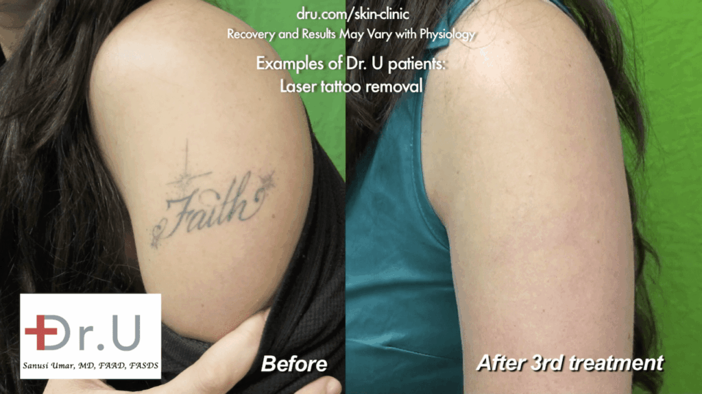 After three sessions of tattoo laser removal with Dr. Umar in Los Angeles, the patient happily shows off her ink-less arm.*