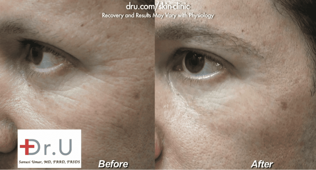 This Venice Beach patient wanted to remove crows feet, so Dr. Umar recommended Belotero.