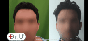 Dr.UGraft Hair Transplant Scar Cover Up For Venice Beach, Los Angeles Patient