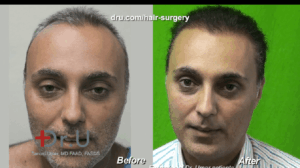 Most patients will be able to enjoy their final results after a hair transplant around eighteen months following their surgery