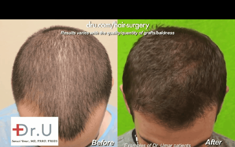 Final hair transplant results will not happen right away. Patients will need to undergo various stages of hair transplant growth before they reach their final outcome