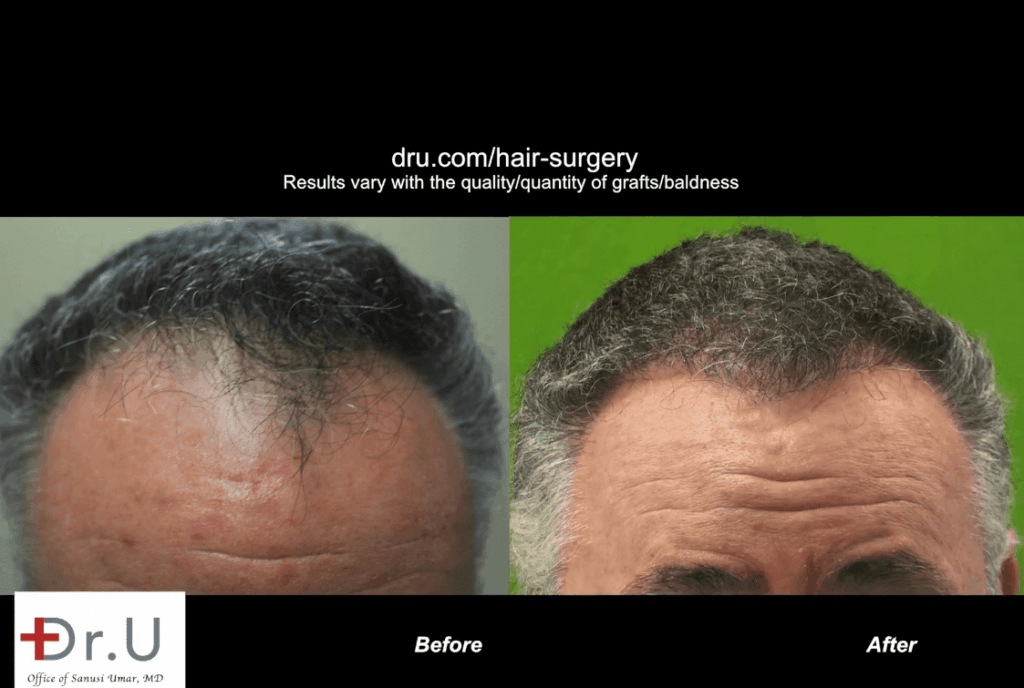 Patient is happy with his conservative hair transplant outcome which advanced his receded hairline and temples to produce a natural-looking improvement *
