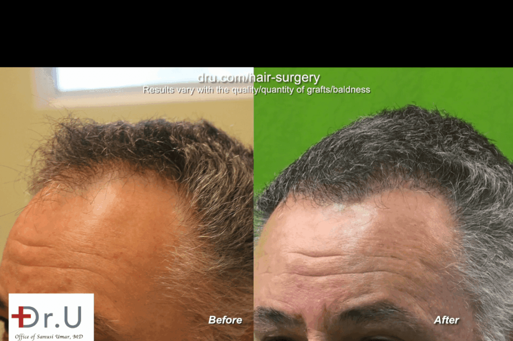 Closeup view of mature hairline and corresponding temple points, before and after surgery *