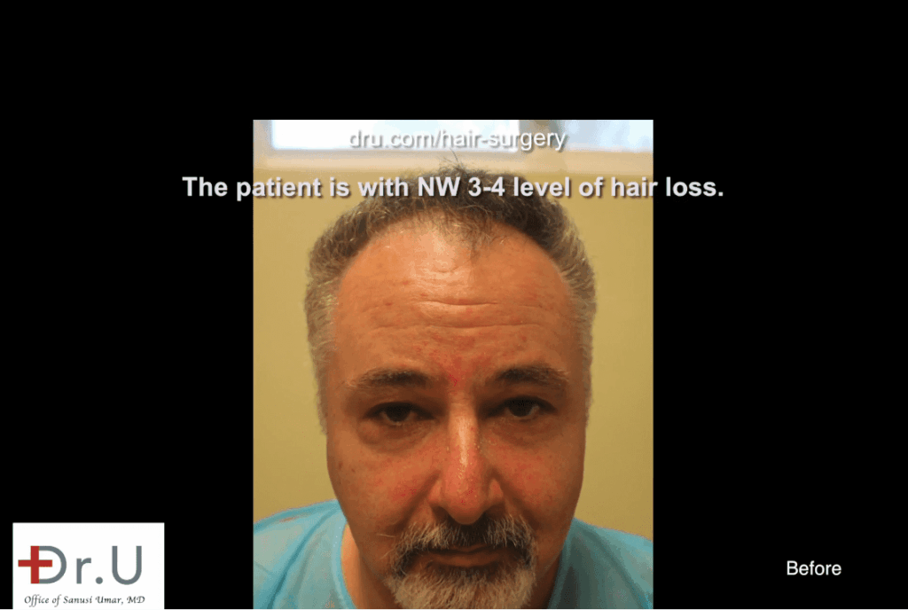 Redondo Beach patient before his Norwood 4 hair transplant*