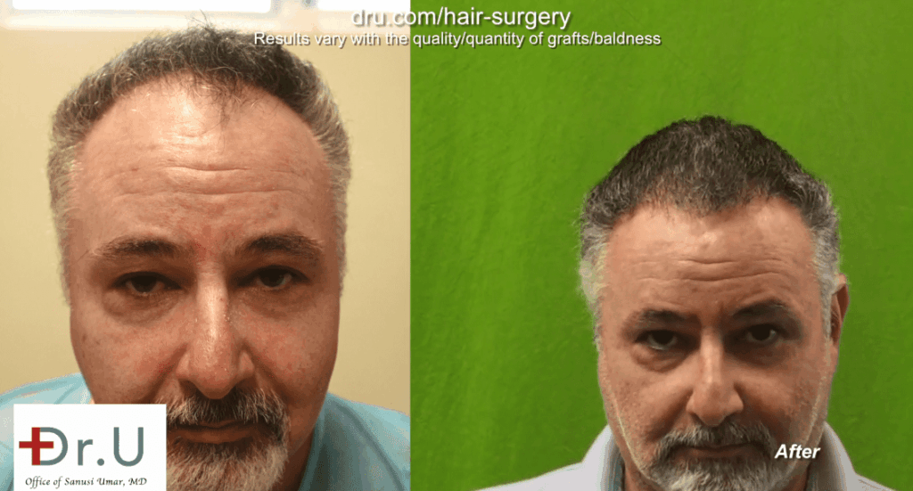 Patient is happy with the way his Norwood 4 hair transplant energized his overall appearance, while maintaining an age-appropriate look *