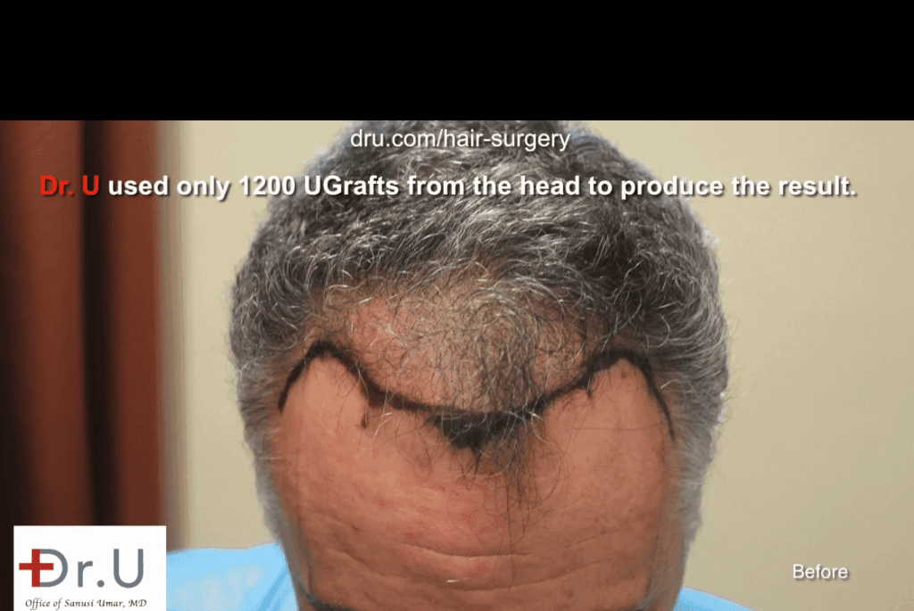 Dr. Umar designed a hairline and temples to create a most natural looking hair transplant outcome.*