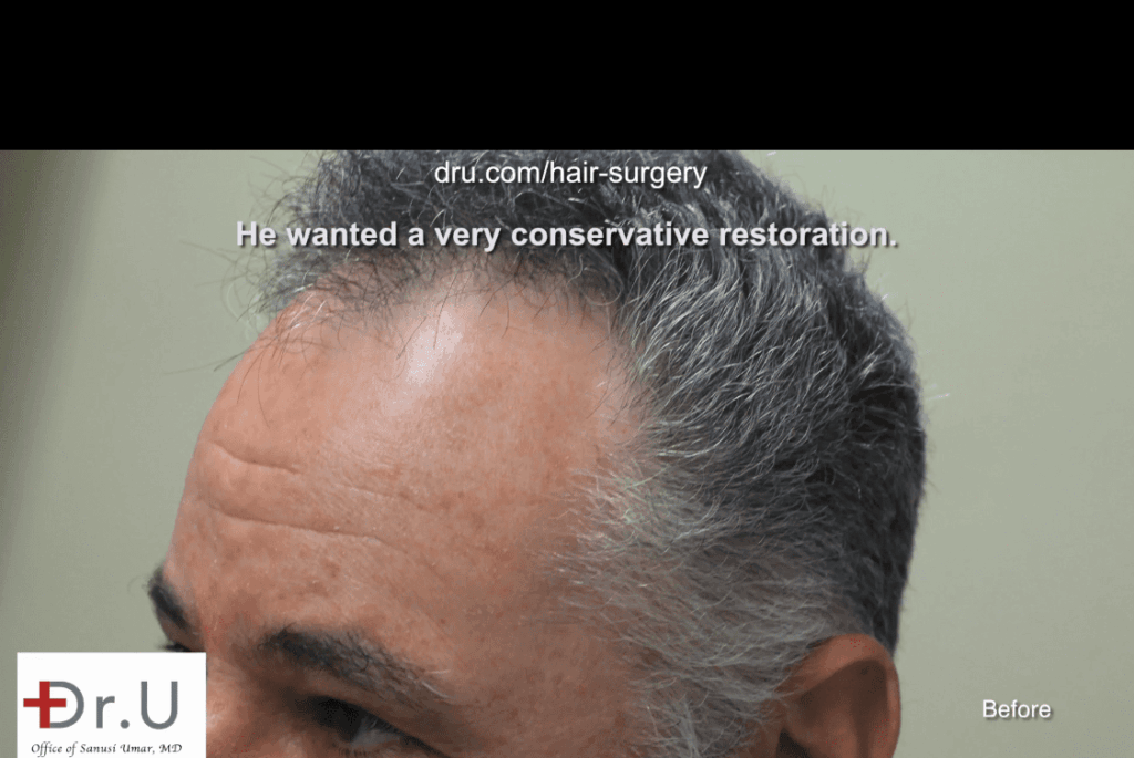 Patient wants the look of a mature hairline that is appropriate for his age*