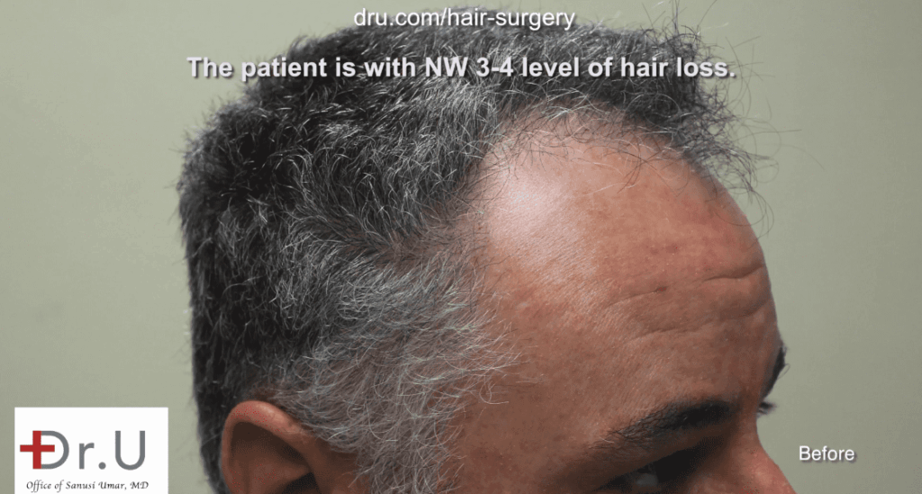 Side view of patient showing receded temples. He hopes to achieve a conservative hair transplant outcome*