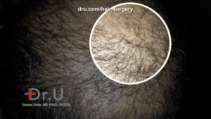 In the initial stages of hair transplant growth, around the third to fourth month, patients may start to notice pimple-like bumps, which actually is a positive sign of new growth