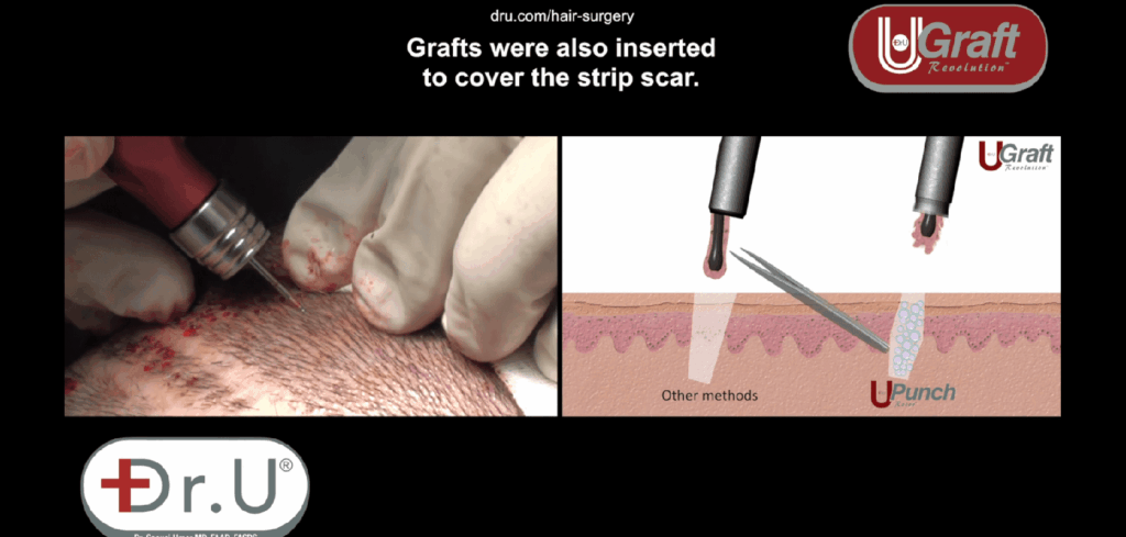 Beverly Hills patient before and after his Dr.UGraft receding hairline surgery before and after