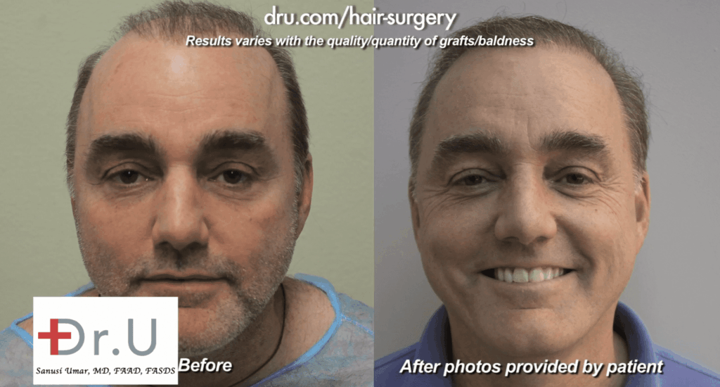 80's Pluggy Doll's Hair Repaired With Dr.UGraft