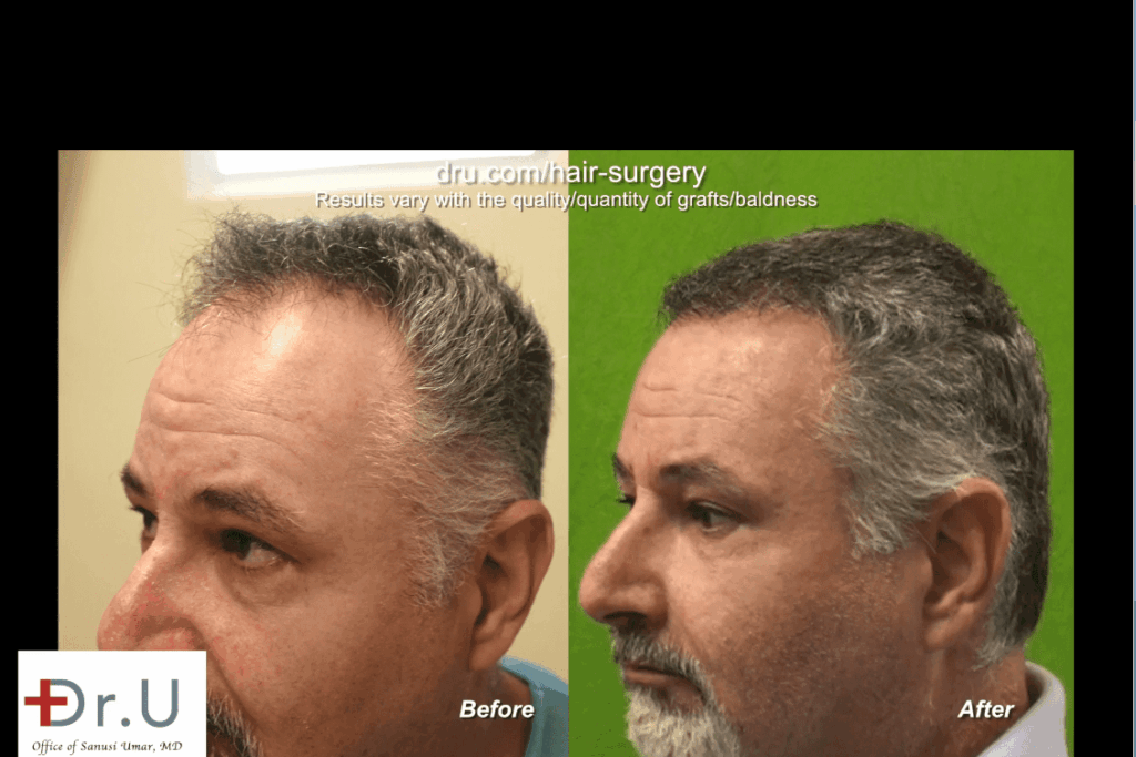 Side view of Redondo Beach patient before and after his Norwood 4 hair transplant *