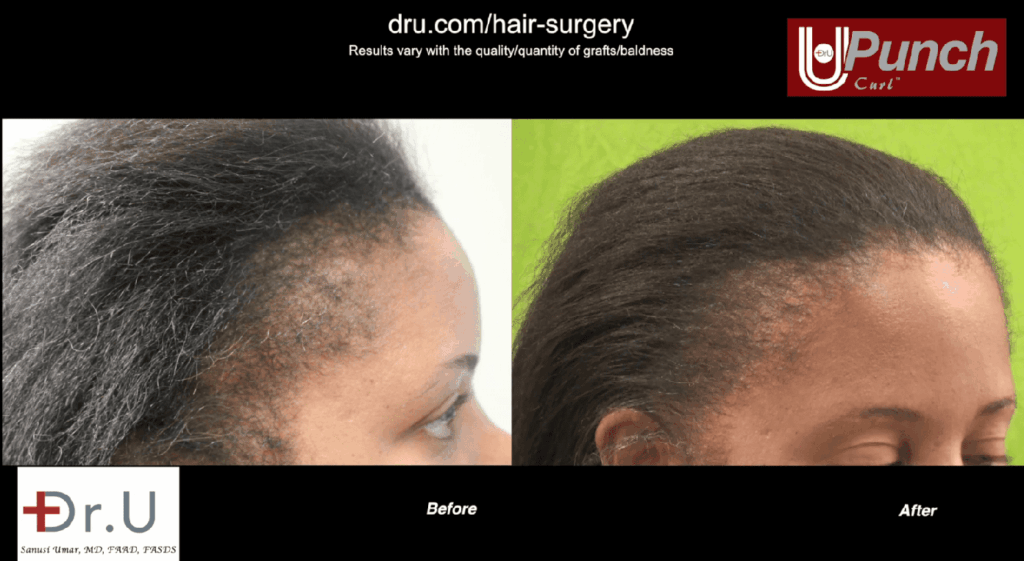 Traction alopecia prevention and treatment: This patient had abused her hair for years with braids, weaves, and tight ponytails. She later underwent the Dr.UGraft procedure to restore her hair.