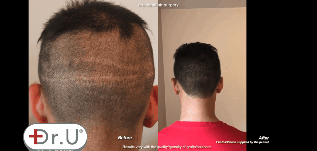 The Dr.UGraft solution for a receding hairline also addressed the temples to produce the results shown *