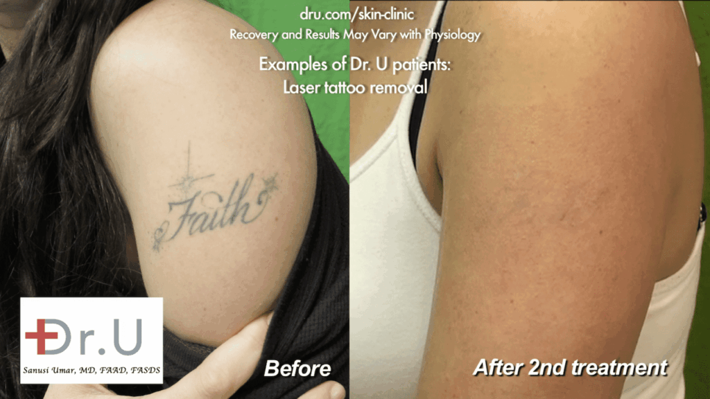 This before and after image shows the results of two sessions of tattoo removal with laser. A faint outline can still be seen, which was addressed in a follow-up session This before and after image shows the results of two sessions of tattoo removal with laser. A faint outline can still be seen, which was addressed in a follow-up session