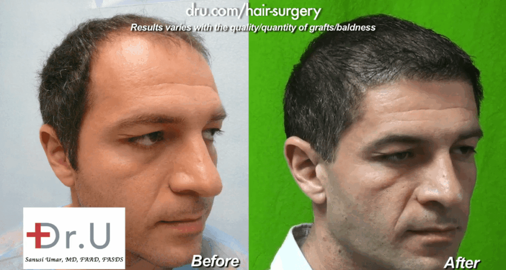 Thinning Hair Transplant Results - 10000 Grafts of Head and Beard Hair Extracted with Dr. UGraft Device