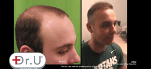 Manhattan Beach Patient Undergoes Dr.UGraft Hair Transplant at Age 23*