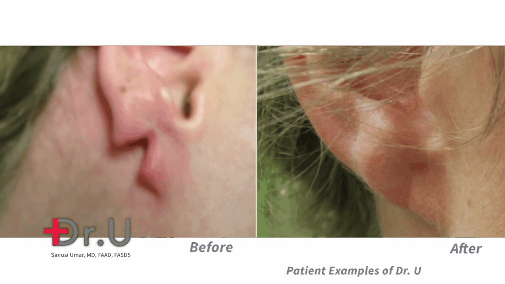 After seeing a rip or tear, many wonder "Will a split earlobe repair itself?". The answer, Dr. Umar explains, is generally "no".*