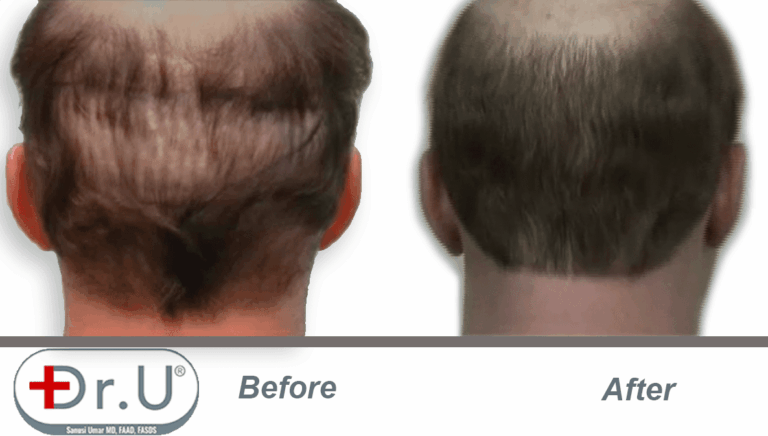 Before and after view of scalp donor area which was repaired with body hair grafts. Filling in this area was one of the goals of the patient's hair transplant repair for hairpiece integration. Before and after view of scalp donor area which was repaired with body hair grafts. Filling in this area was one of the goals of the patient's hair transplant repair for hairpiece integration.