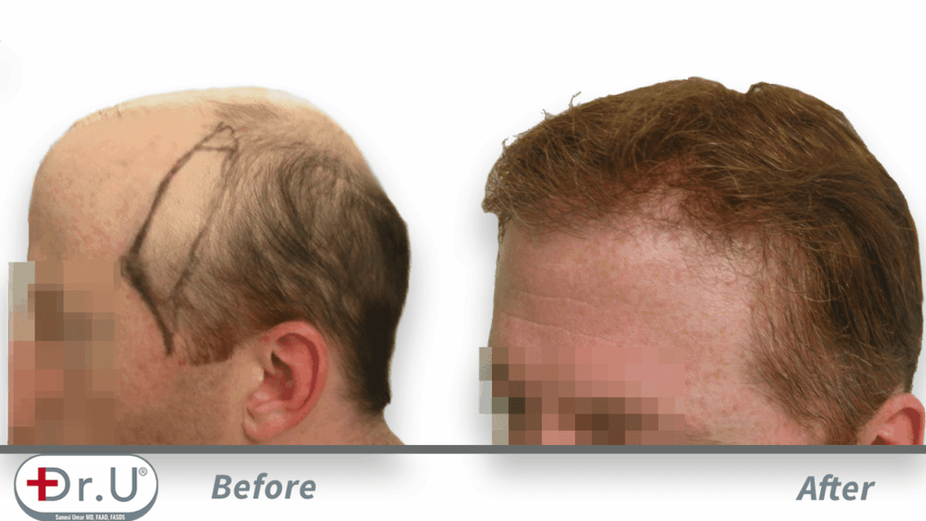 Redondo Beach patient depicted from the side, before and after his Dr.UGraft hair transplant repair for hairpiece integration.