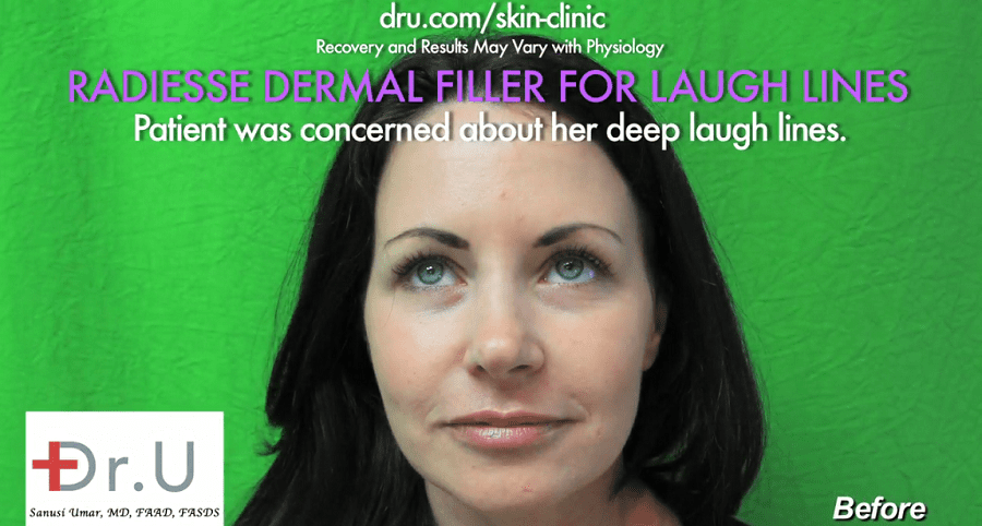 Patient before her treatment with Radiesse, hoping to benefit from the right nasolabial fold filler 