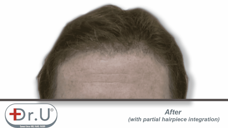 Final results showing patient's partial hairpiece integration with the hairline and temples created during his Dr.UGraft procedure. Final results showing patient's partial hairpiece integration with the hairline and temples created during his Dr.UGraft procedure.