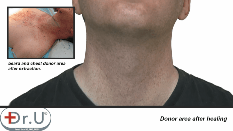 Beard region on patient's face and neck healed without noticeable signs of redness or scarring, following his hair transplant and hairpiece combination surgery using Dr.UGraft technology. Beard region on patient's face and neck healed without noticeable signs of redness or scarring, following his hair transplant and hairpiece combination surgery using Dr.UGraft technology.