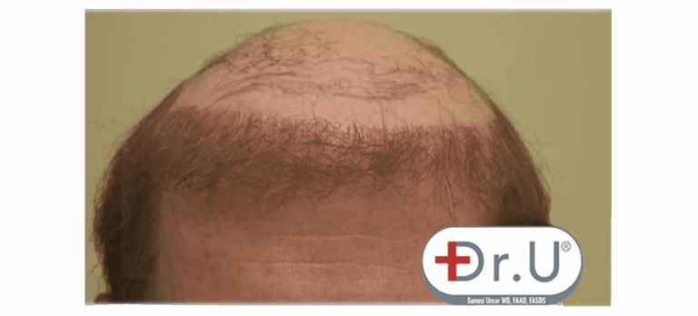 Front view of patient's final outcome. He intends to use a partial hairpiece to blend in naturally with his hairline and temples