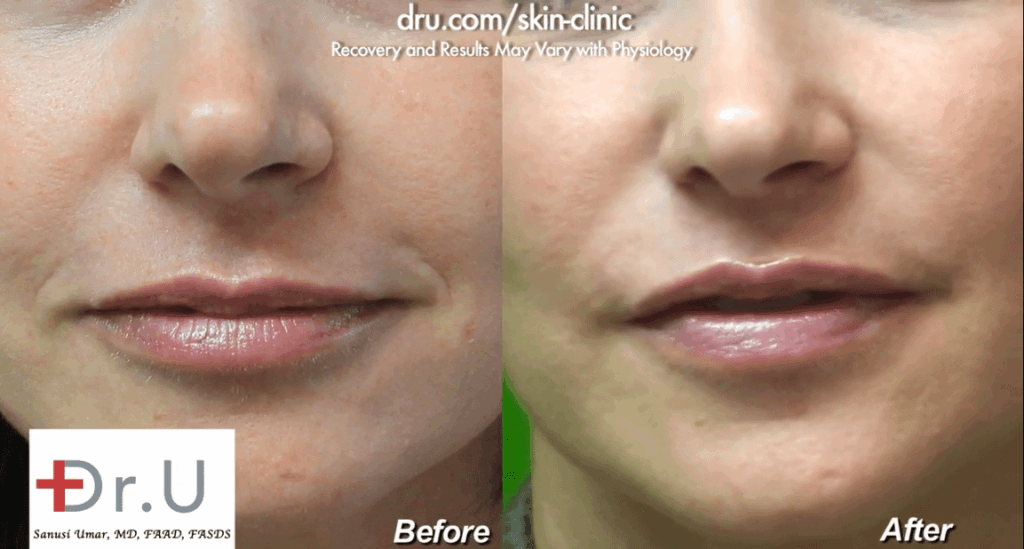 Dr. Umar used Radiesse for marionette lines that were starting to develop on this patient