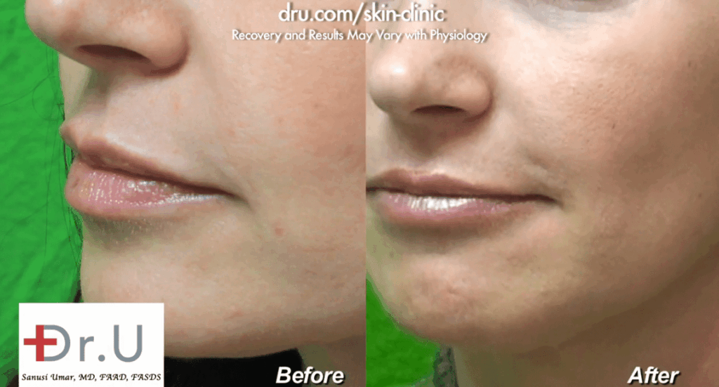Close-up, side view of patient's treatment using Radiesse for nasolabial folds before and after 