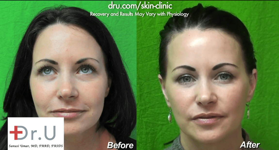 Patient is a firm believer that Radiesse is the best filler for nasolabial folds