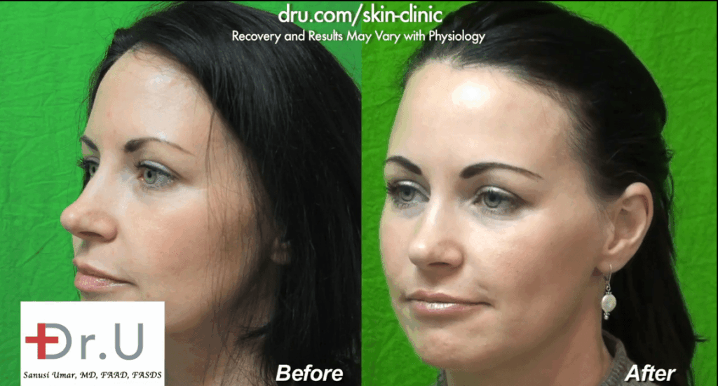 The simple use of a nasolabial fold filler can greatly improve the youthfulness of a person's face