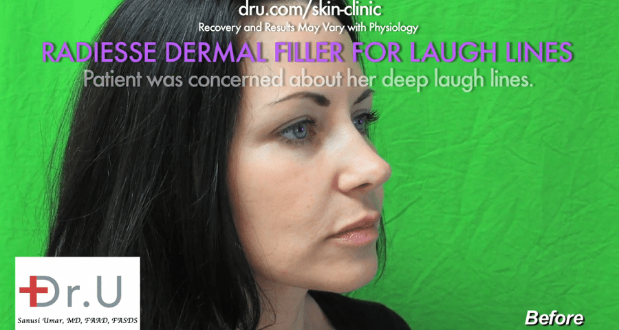 Side view of patient showing the depleted facial volume in her lower face that required treatment with a smile lines filler
