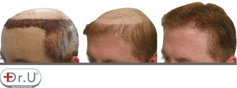 Progression of results for hair transplant and hair piece combination. On the left is the recipient area directly after hair transplant. In the middle is the full result of the hairline and temple reconstruction. On the right is the full result of the procedure, with the patient's hairpiece of choice. Progression of results for hair transplant and hair piece combination. On the left is the recipient area directly after hair transplant. In the middle is the full result of the hairline and temple reconstruction. On the right is the full result of the procedure, with the patient's hairpiece of choice.