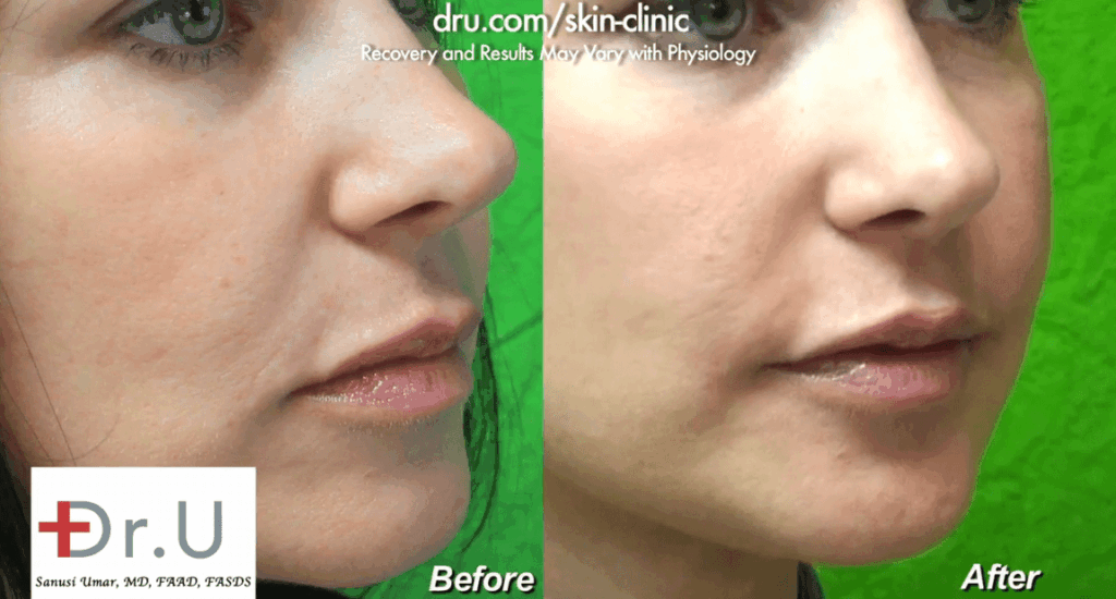 Radiesse as a smile lines filler created the look of more volume in the patient's lower face
