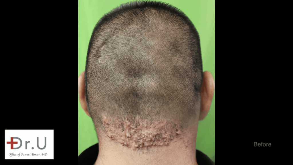 The Walnut Park patient sought a cure for chronic razor bumps behind head after previous treatments at other clinics had failed.