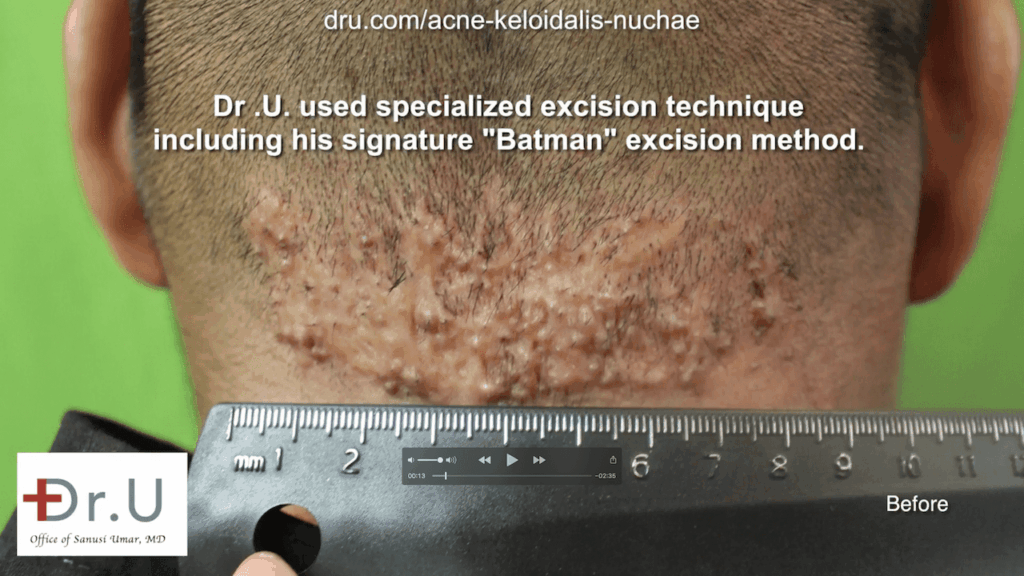 This Walnut Park patient endured symptoms of AKN like a bump on head for years before consulting at the Dr. U AKN Bump Clinic.