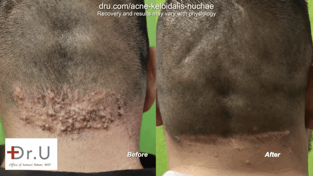 This patient finally found a cure for razor bumps behind head with Dr. U in Los Angeles. Dr. U's unique surgical excision technique helped return this patient to his normal cosmetic appearance.