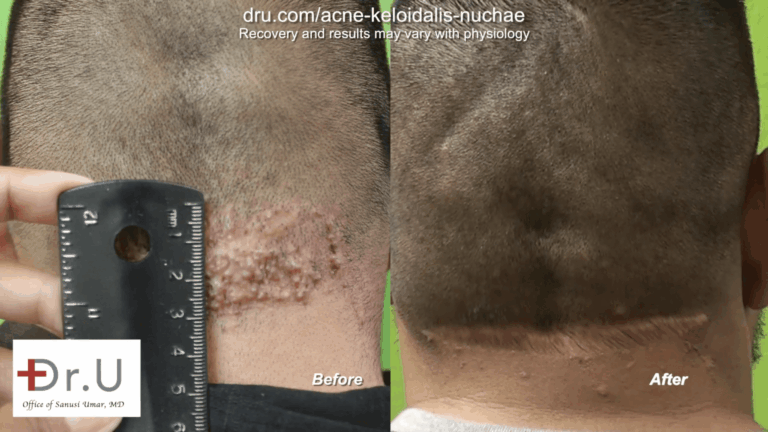 When a bump in back of head hurts, many do not know where to pursue treatment or what initial steps to take. This Walnut Park patient finally found a surgical cure for the AKN pimples on the back of the head and neck with Dr. U.*