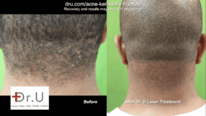 The East Los Angeles patient shows off his new, AKN-free back hairline. No longer self-conscious of the bumps on head scalp, he is able to wear his hair as short as he likes without fear of exposing the hard simple-like bumps previously on his nape.*
