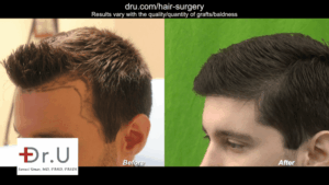 young-age-hair-transplant-using-dr-ugraft-qualifies-most-young-adults